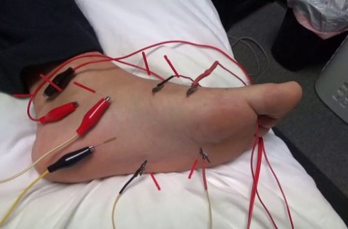 electrical dry needling for plantar fasciitis