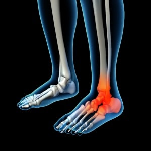 Plantar Fasciitis Damage