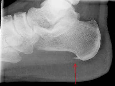 Heel Spur