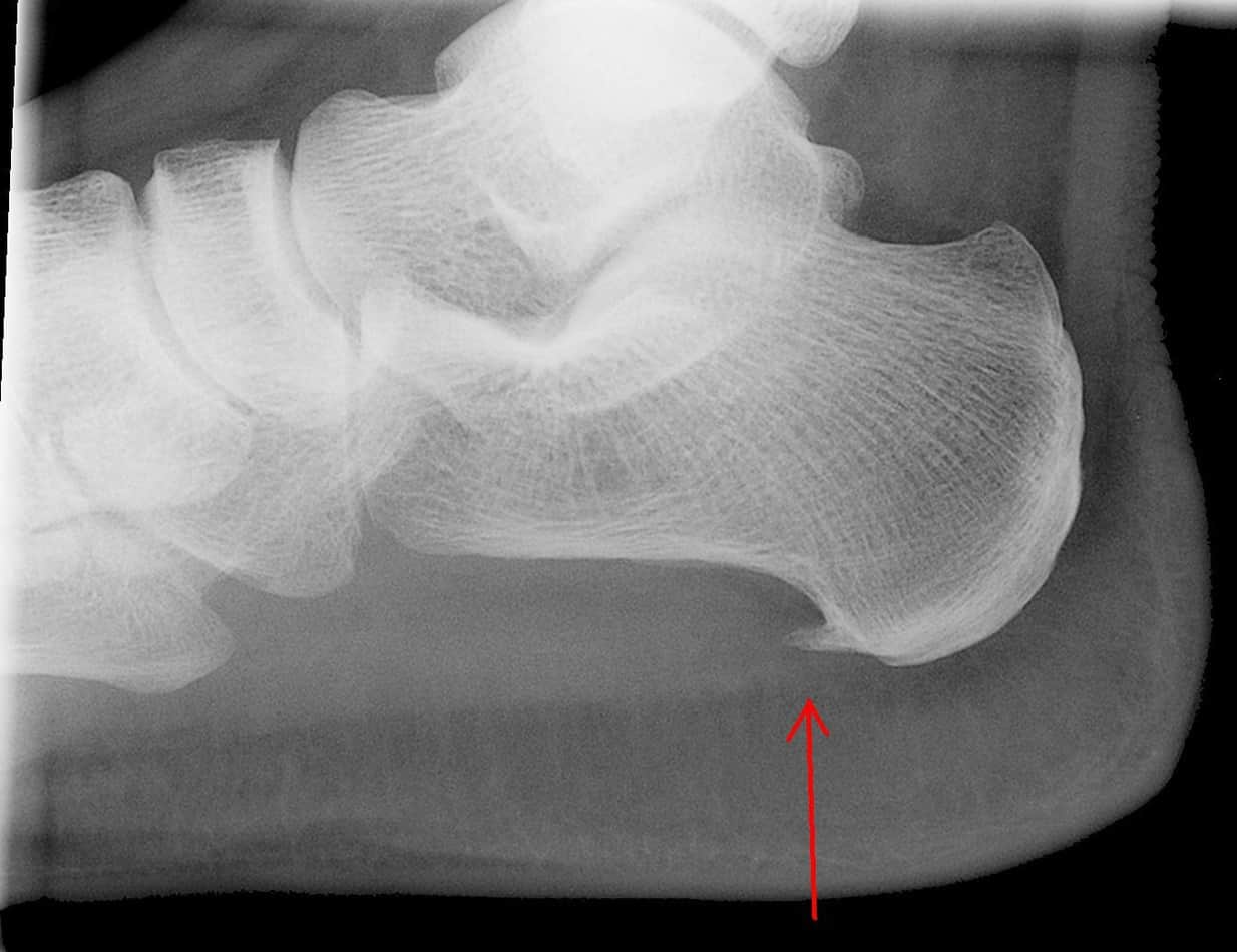 Calcaneal Spur